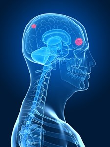 bigstock-cerebral-tumor-7170747.jpg