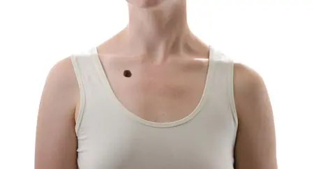 The -Warning -Signs -of -Skin -Cancer