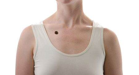 The -Warning -Signs -of -Skin -Cancer