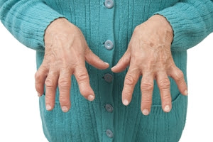 Understanding The Basics Of Rheumatoid Arthritis